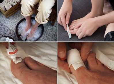 Schwelende Füße und Auftragen von Harnstoffcreme auf den von Pilzen befallenen Nagel