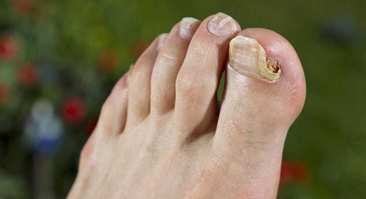 Beschädigung der Nagelplatte mit Pilz an den Beinen