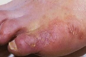 Manifestationen einer Pilzinfektion auf der Haut der Beine