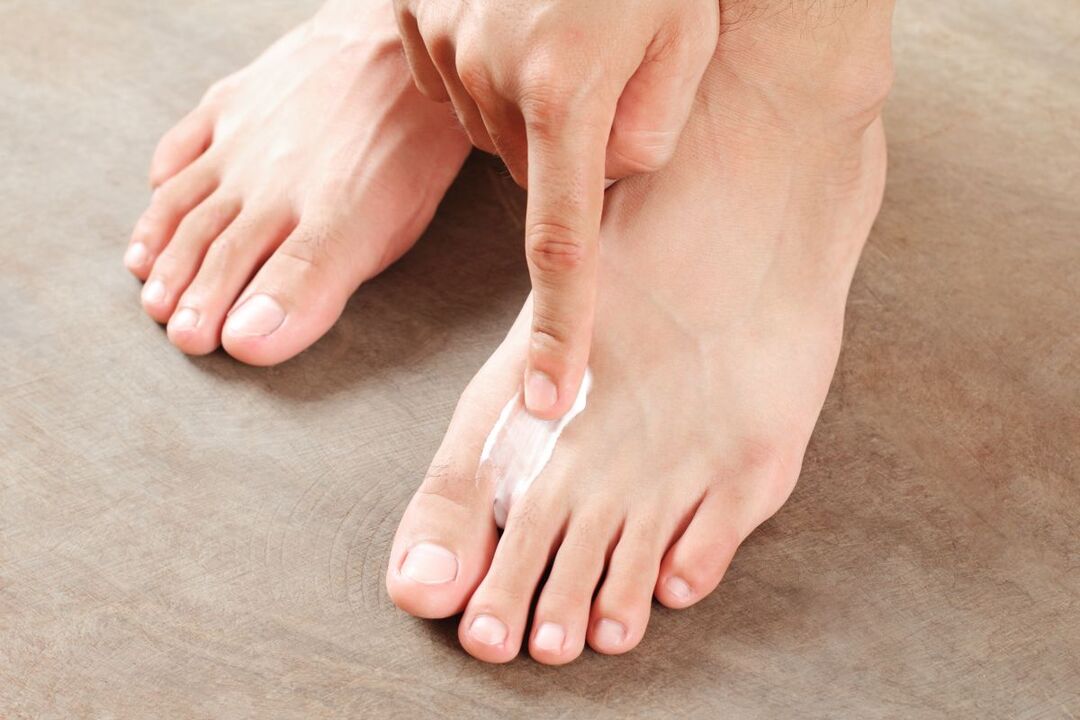 Behandlung von Pilzen an den Füßen mit Salbe