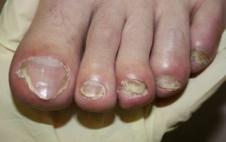 die symptome von nagelpilz