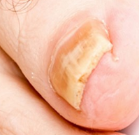 Fingernagel betroffene, die durch den pilz