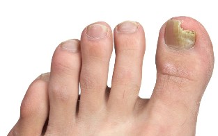 die symptome von nagelpilz